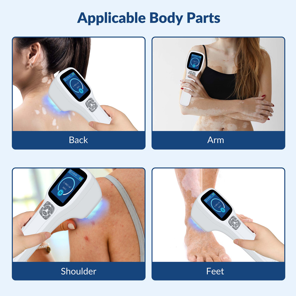 ボディ・フェイスケア UVB LIGHT THERAPY DEVICE UL-01 308nm 308nm